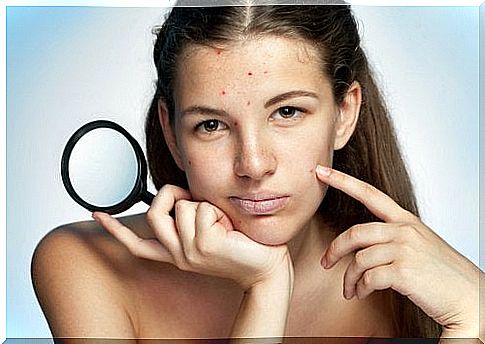 girl with acne