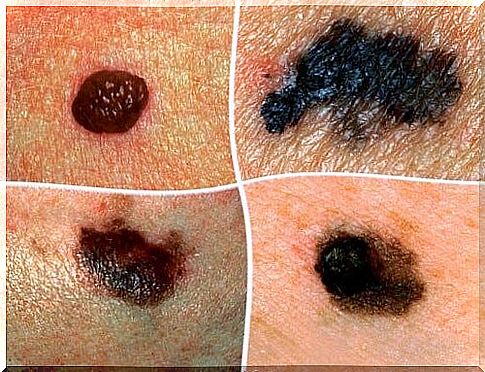 skin changes cancer