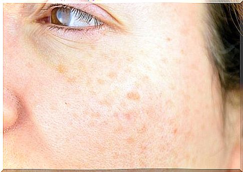 Skin spots appear with age and are usually caused by overexposure to the sun