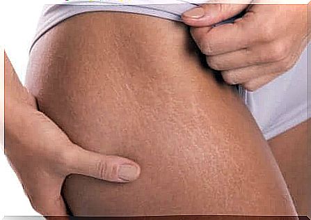 Woman with stretch marks on her thigh.