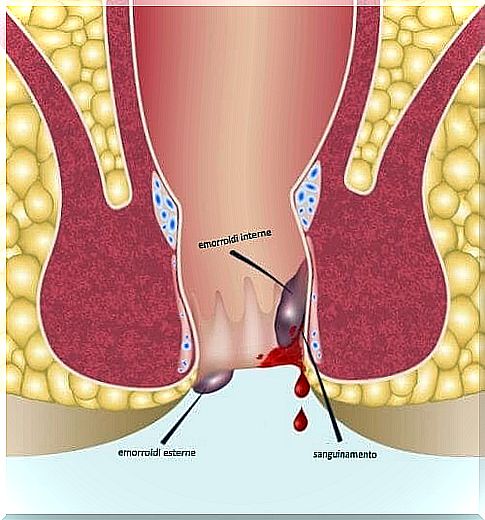 Anoscopy: what is it and when is it indicated?