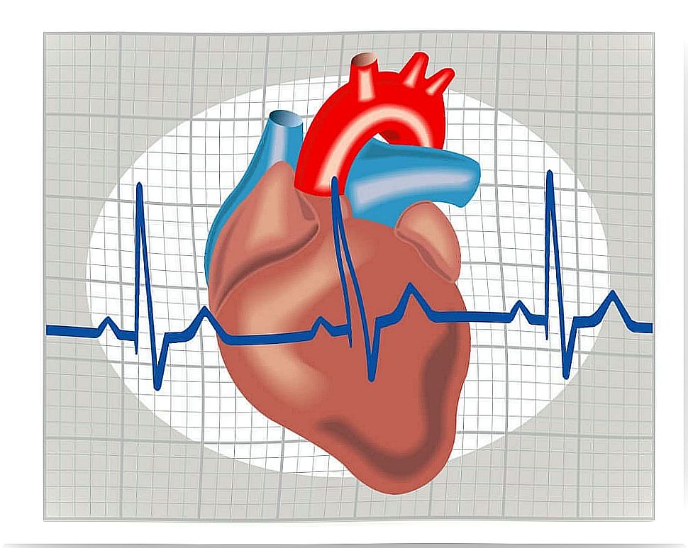 Arrhythmia