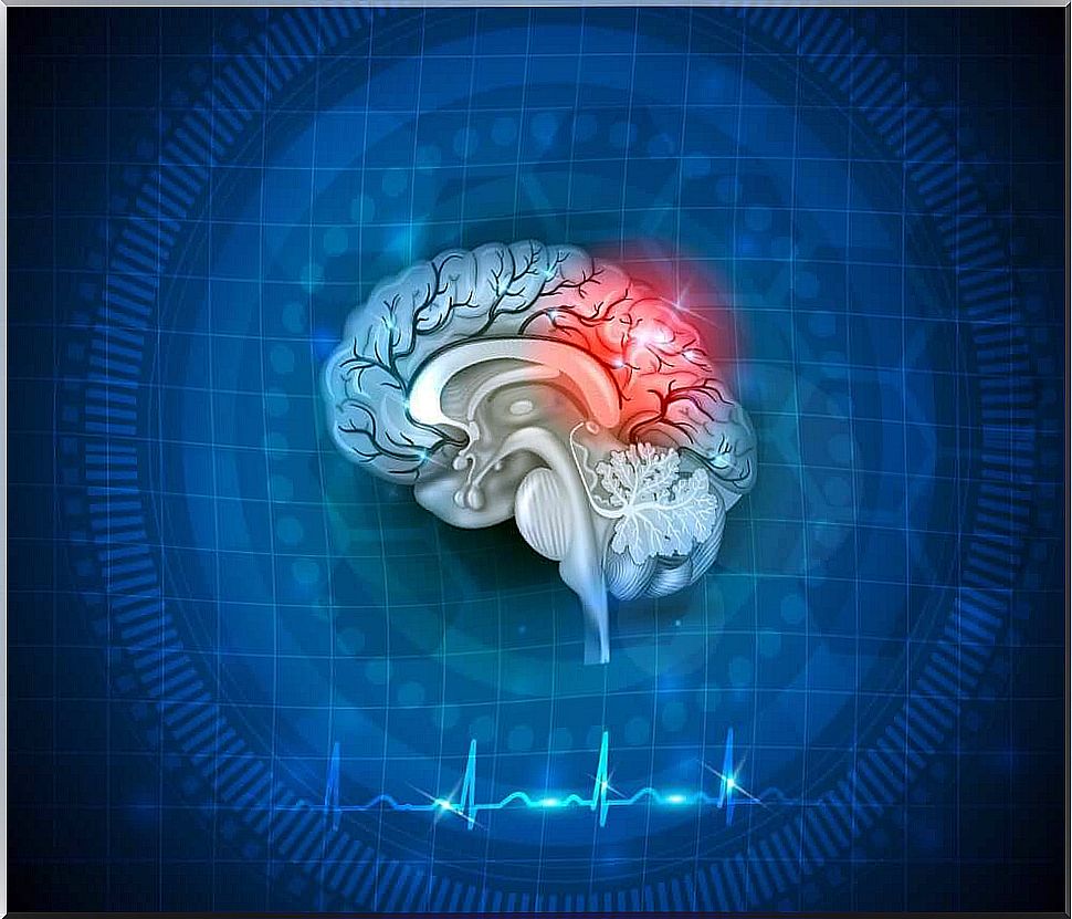 Depiction of the brain and stroke