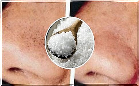 Blackheads and pimples: how to fight them with salt