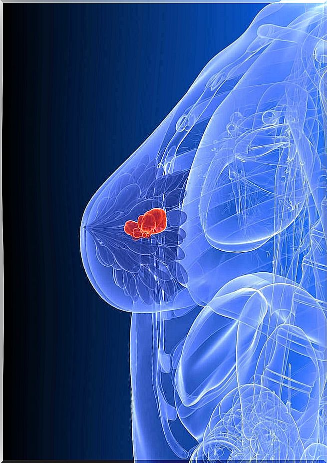 Image of female body and breast cancer