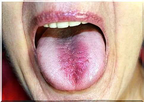 Burning mouth syndrome: symptoms and causes