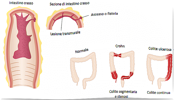 Crohn's disease