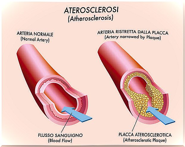 Arteriosclerosis