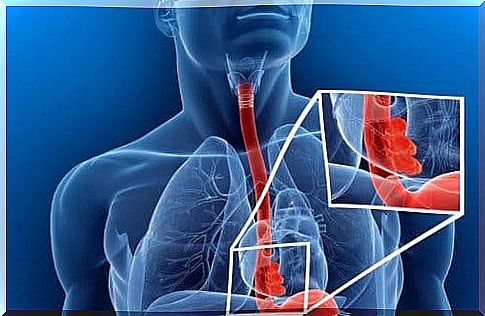 Esophageal foreign body