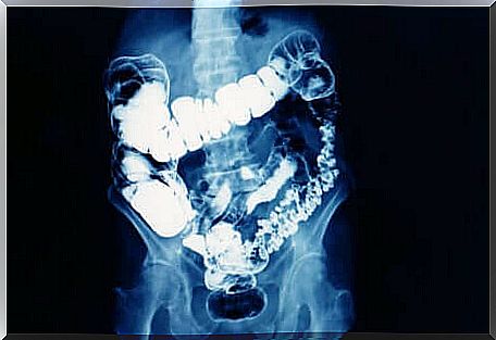 X-ray of the intestine.