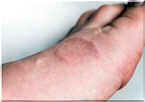 Granuloma annulare: what is it?