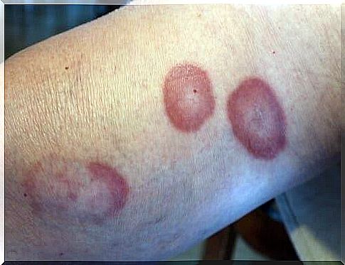 Granuloma annulare on the arm