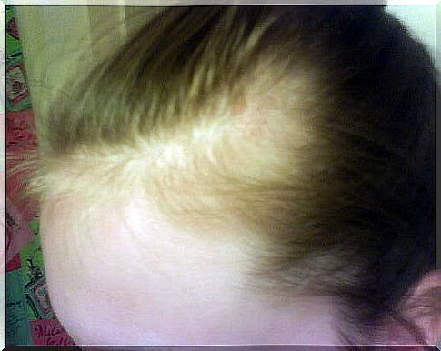 Alopecia