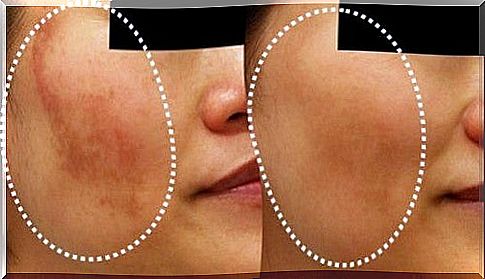 Natural treatment for melasma