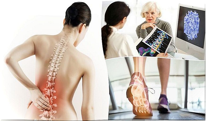 Osteoporosis: 6 facts to know