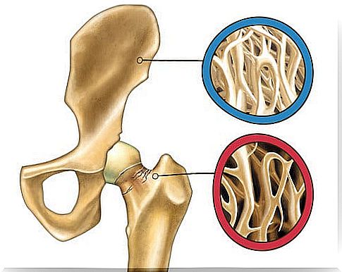 Osteoporosis