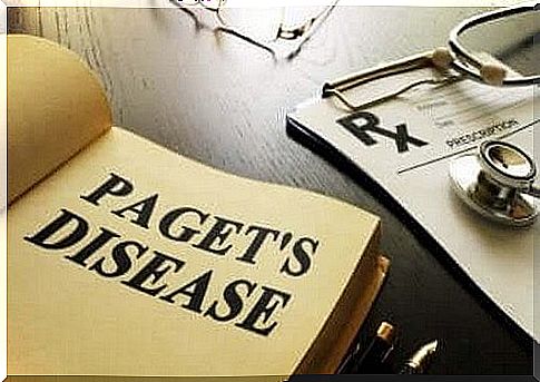 Paget's disease, everything you need to know