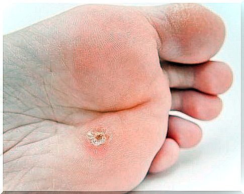 Plantar wart: symptoms and treatment