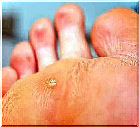 Plantar wart.