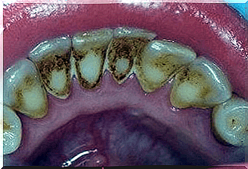 Plaque: how to get rid of it to improve oral health