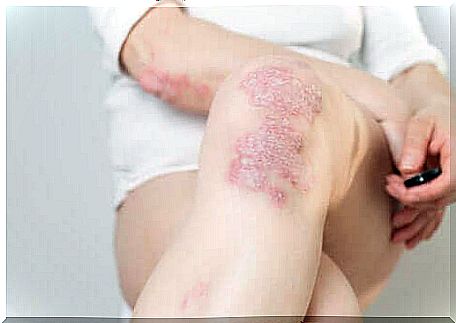 Woman with psoriasis on her knees.