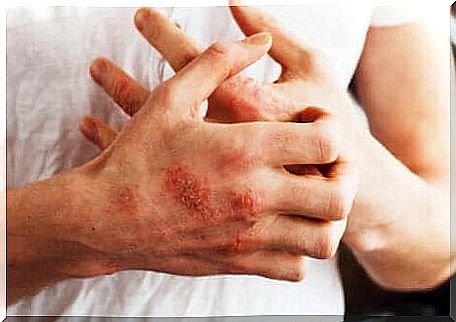 Psoriasis and coronary artery disease are related.