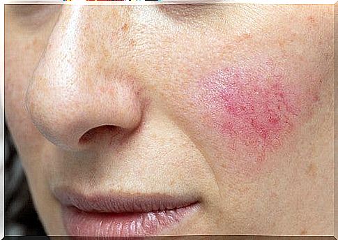 Rosacea on the skin of the face.