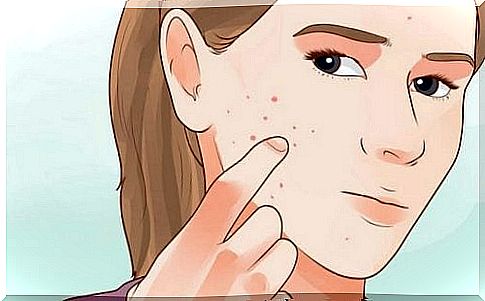 Acne as a symptom of hormonal imbalance