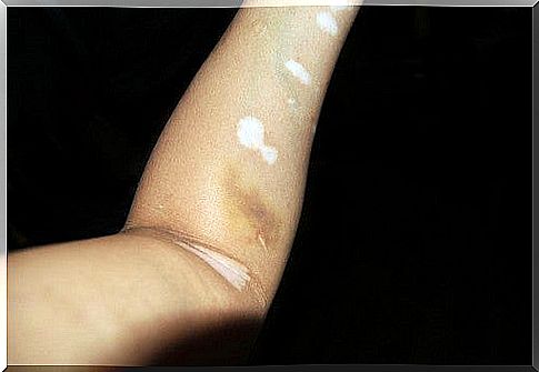 Treat Vitiligo with Natural Remedies