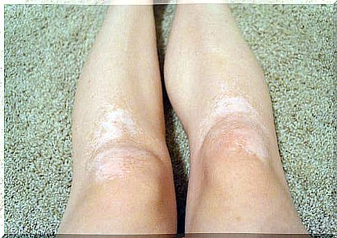 Vitiligo on the legs