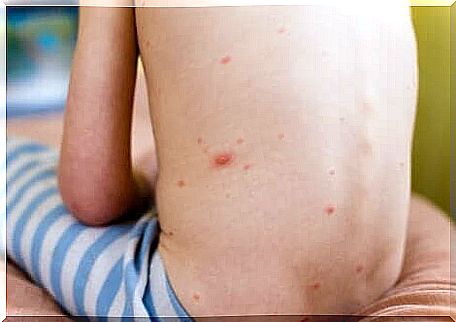 Child sitting on bed with atopic dermatitis on his back.